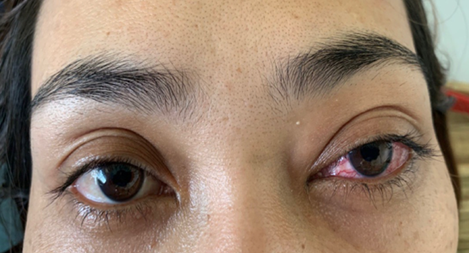 Hai tháng đau mắt đỏ, nữ bệnh nhân không ngờ mắc bệnh hiếm gặp 