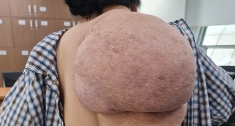Người phụ nữ đeo khối u khổng lồ trên lưng 30 năm 