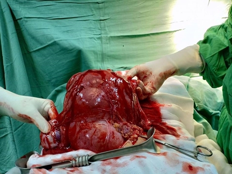 Bóc tách khối u xơ tử cung “khủng” ra khỏi người bệnh nhân 