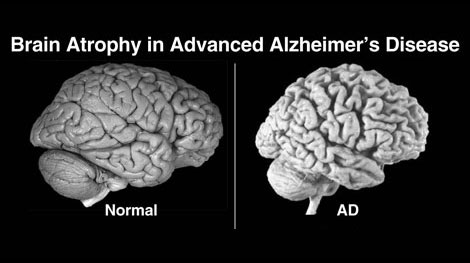 Bệnh Alzheimer lây truyền qua máu?
