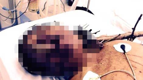 Ngã xuống hố trong lúc làm vườn, bị tre đâm xuyên họng