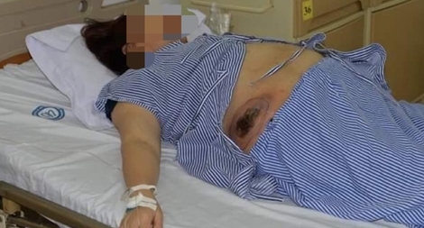 Đắp thuốc lá trôi nổi, bệnh nhân tiểu đường bị nhiễm trùng nặng