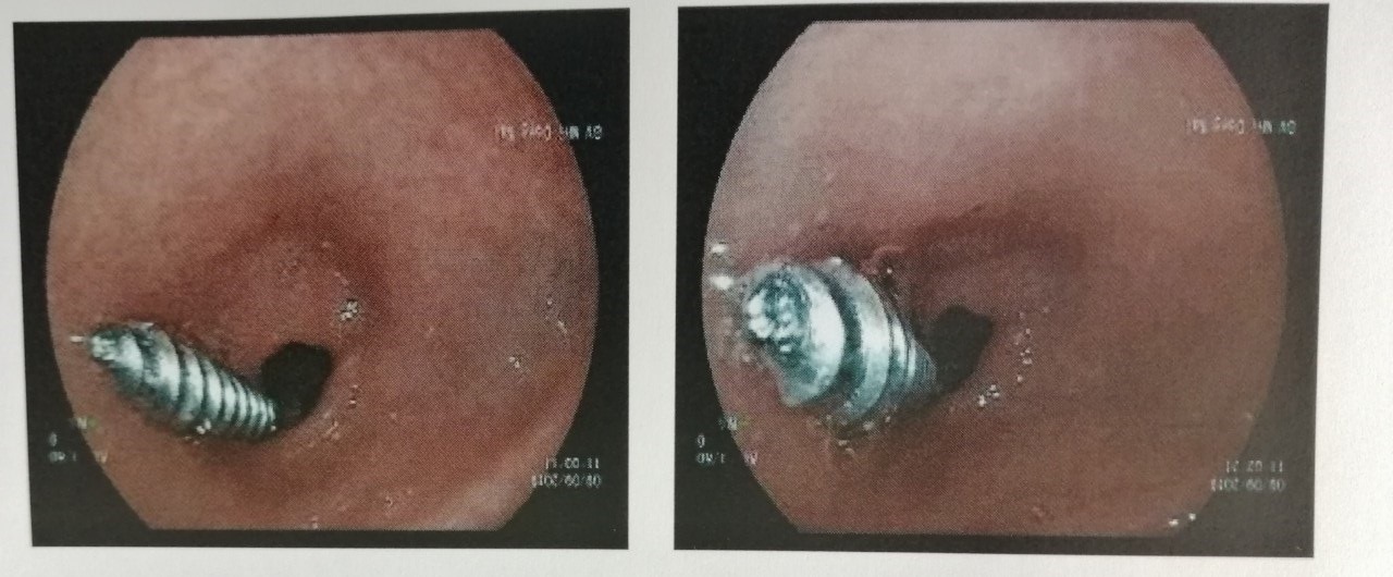 Phẫu thuật nội soi, lấy ốc vít từ da dày bé trai 18 tháng tuổi