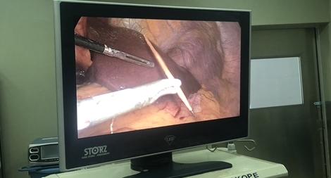 Nằm võng nuốt phải tăm tre, người đàn ông thủng dạ dày