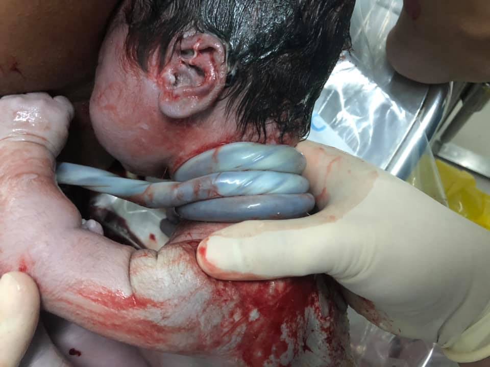 Đỡ đẻ thành công thai nhi có dây rốn vừa thắt nút vừa quấn cổ 