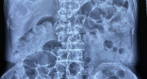 Lần đầu tiên thực hiện thành công đặt stent điều trị ung thư đại trực tràng tại phía Nam