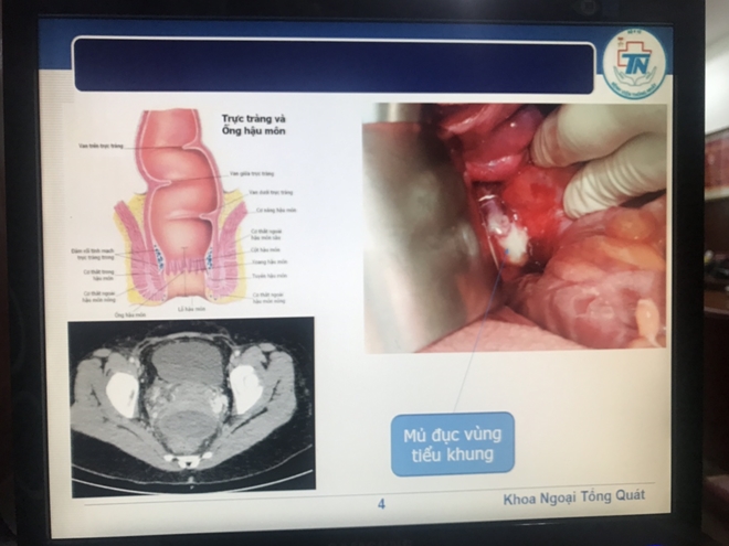 Thủng trực tràng sau khi điều trị tại một phòng khám tư