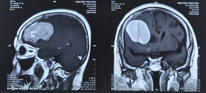 "Giải thoát" khối u màng não khổng lồ cho cụ bà 76 tuổi