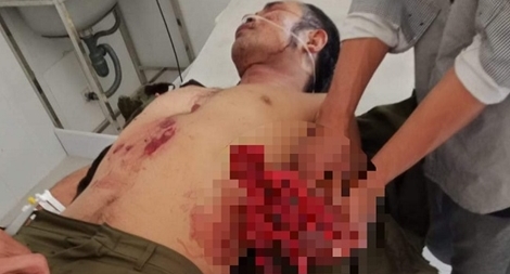 Chế mìn đánh cá, 7 người bị thương