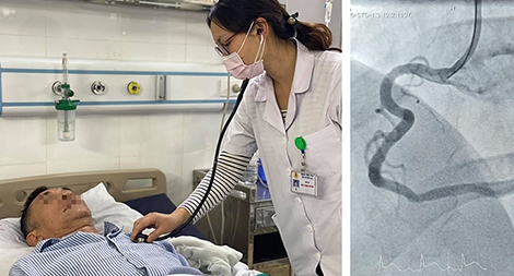 Cứu sống hai bệnh nhân nhồi máu cơ tim biến chứng nặng