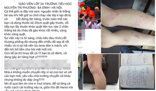 Kỷ luật cô giáo dùng thước đánh học sinh bầm tím chân